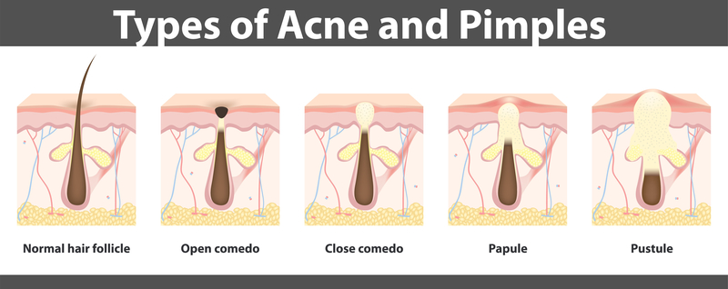 Types of Acne and Pimples