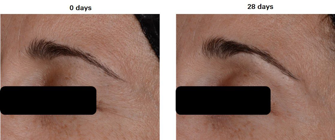 DAWNERGY in-vivo Before and After Wrinkles photos