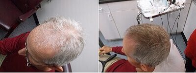 Before and after photos of participants in Gregory L. Smith and John Satino’s study of CBD’s effects on hair growth