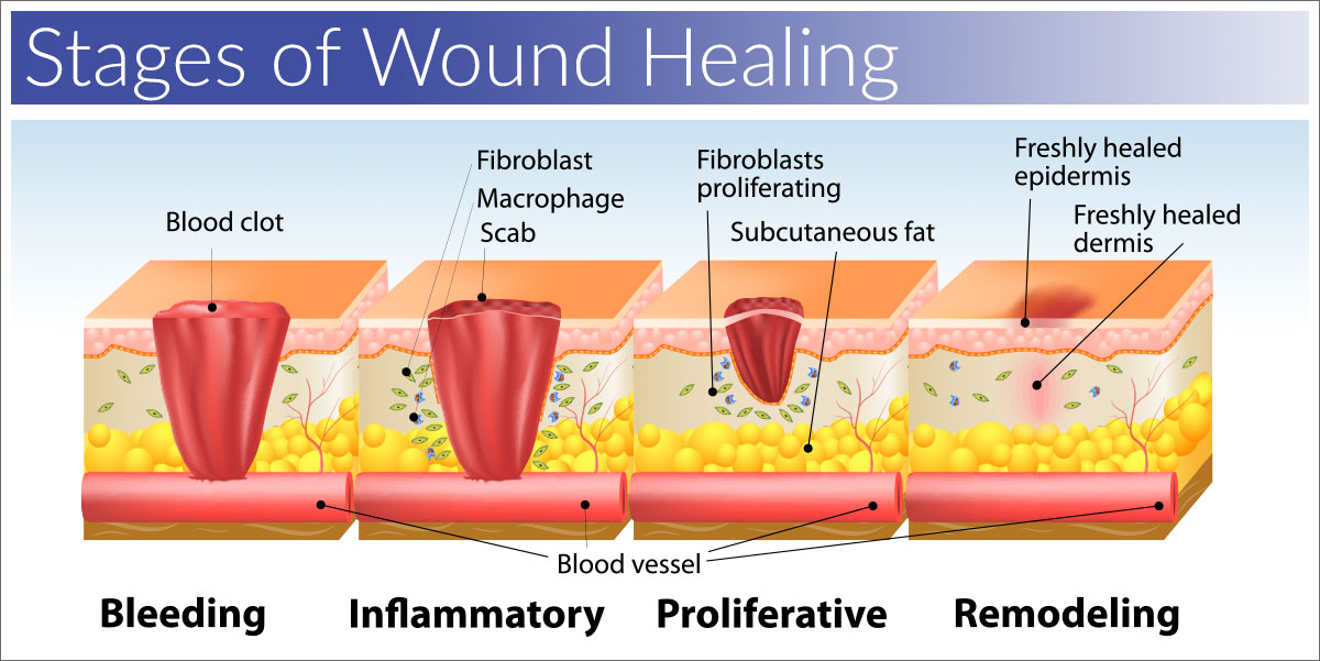 Stages of wound healing