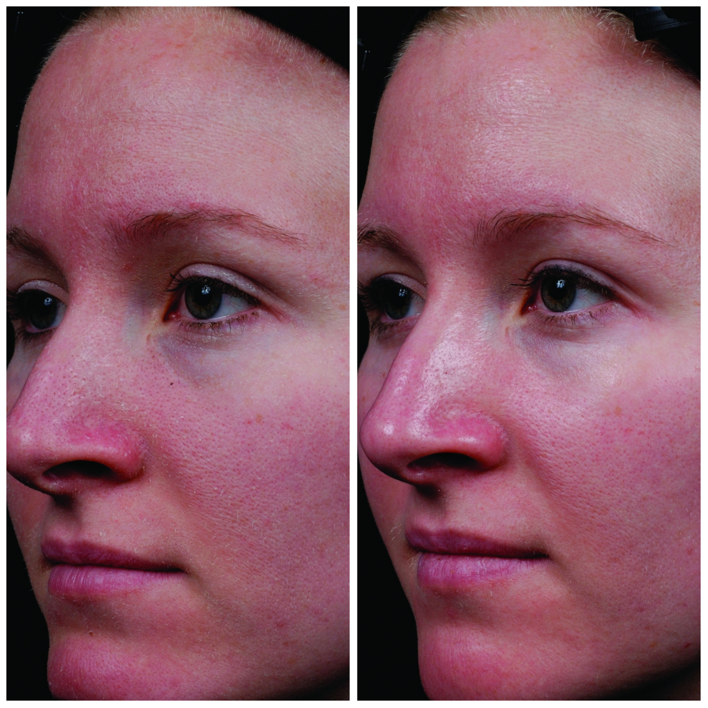 A participant before trying the serum layered with moisturizer (left) and after two weeks of treatment (right)